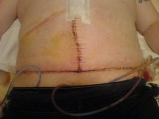 hernia double surgery pic some then