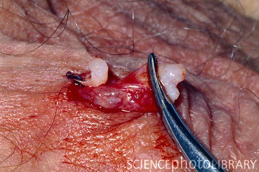 M8600199-Clamping_vas_deferens_during_a_vasectomy_operation-SPL.jpg