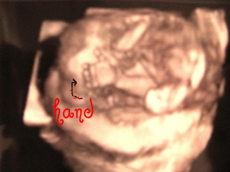 3d ultrasound 20 weeks boy. 2nd and 3rd pic from 20 week