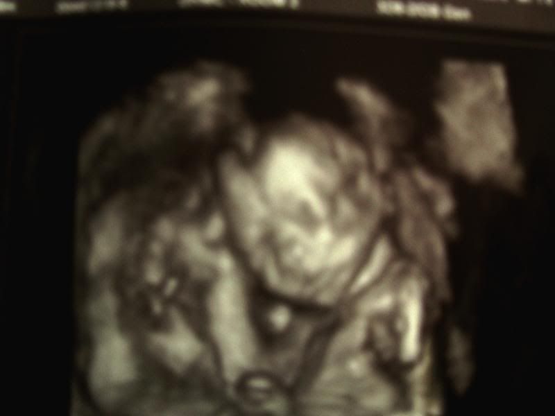 3d ultrasound 20 weeks boy. 2nd and 3rd pic from 20 week